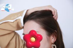 -大麦微针植发丨全国连锁