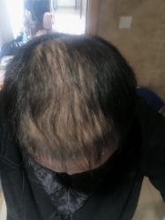 点击看大图 -大麦微针植发丨全国连锁