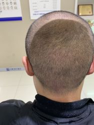 体验后-大麦微针植发全国连锁