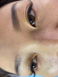 体验前-爱莎扁平疣·汗管瘤·斑痣中心