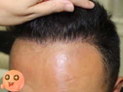 -大麦微针植发丨全国连锁