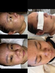 -塑青春&伊肤泉祛痘皮肤管理