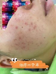 -苗医生草本科技祛痘