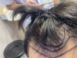 -碧莲盛不剃发植发