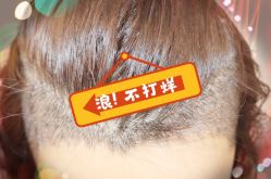 -大麦微针植发全国连锁