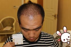 -大麦微针植发丨全国连锁