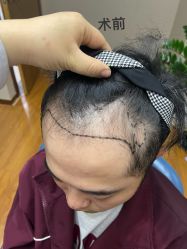 -大麦微针植发全国连锁