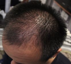 -大麦微针植发丨全国连锁