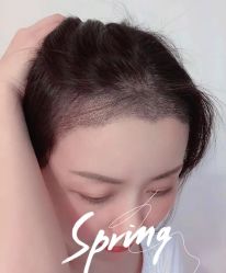 -大麦微针植发全国连锁
