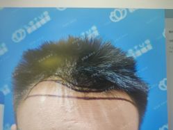 -碧莲盛·不剃发植发