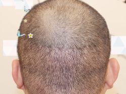 -大麦微针植发全国连锁