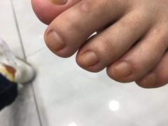 -世龙世家灰指甲·甲沟炎·跖疣护理·修脚(东江湾路店)