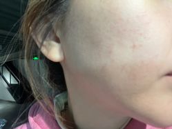 体验后-安那般那皮肤年轻化ANAPANA