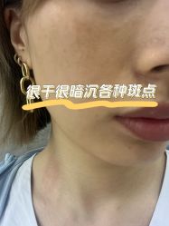 体验前-杭州米兰柏羽医疗美容医院