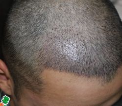 -大麦微针植发丨全国连锁