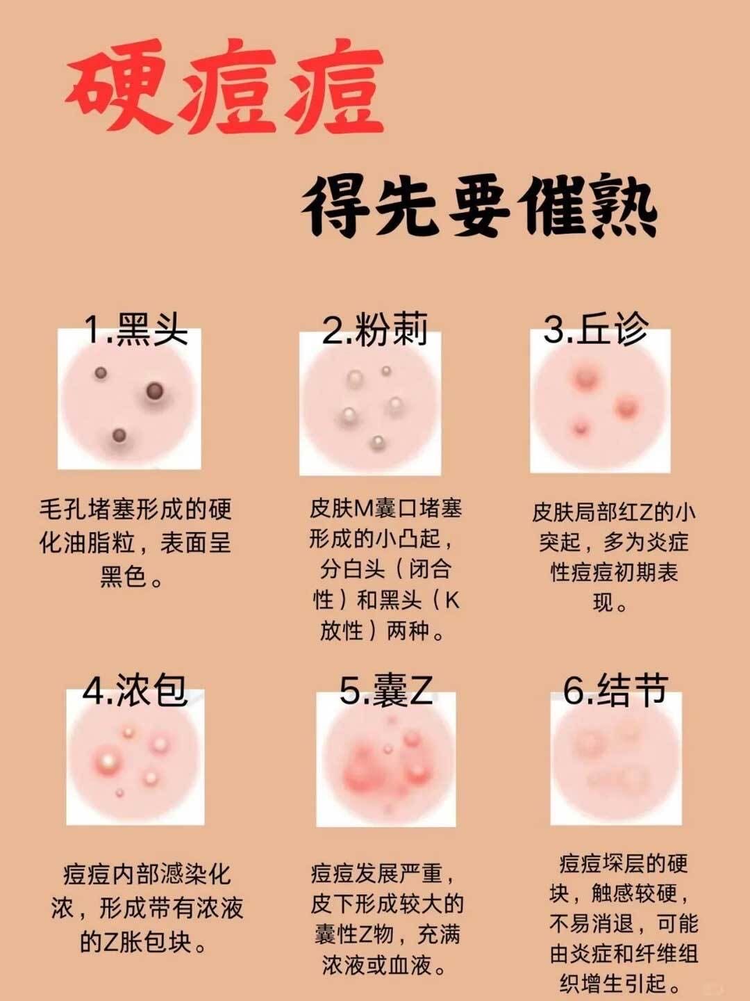 肿硬块痘痘部位进行热敷,有助于促进血液循环,软化硬块痘痘
2,催熟