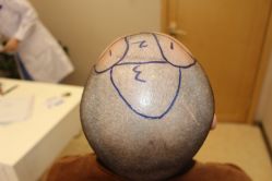 -大麦微针植发丨全国连锁