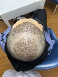 体验后-大麦微针植发全国连锁