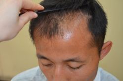 -大麦微针植发丨全国连锁