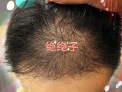 -大麦微针植发全国连锁