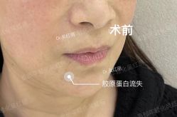 体验前-杭州米兰柏羽医疗美容医院