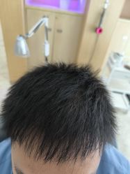 -大麦微针植发丨全国连锁