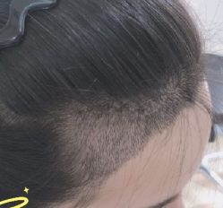 -大麦微针植发丨全国连锁
