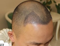 -大麦微针植发丨全国连锁