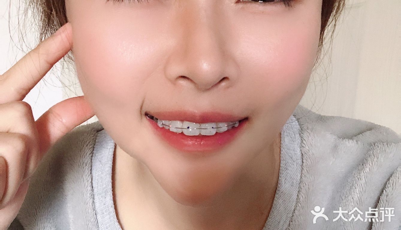 [礼花][礼花]撒花庆祝~！！小美女今天戴上牙套啦