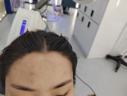 -大麦微针植发全国连锁