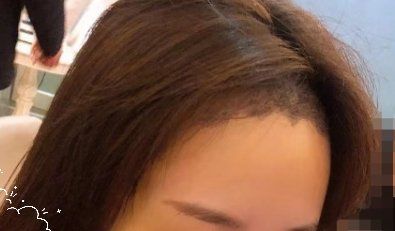 -大麦微针植发丨全国连锁