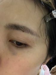 体验后-杭州米兰柏羽医疗美容医院