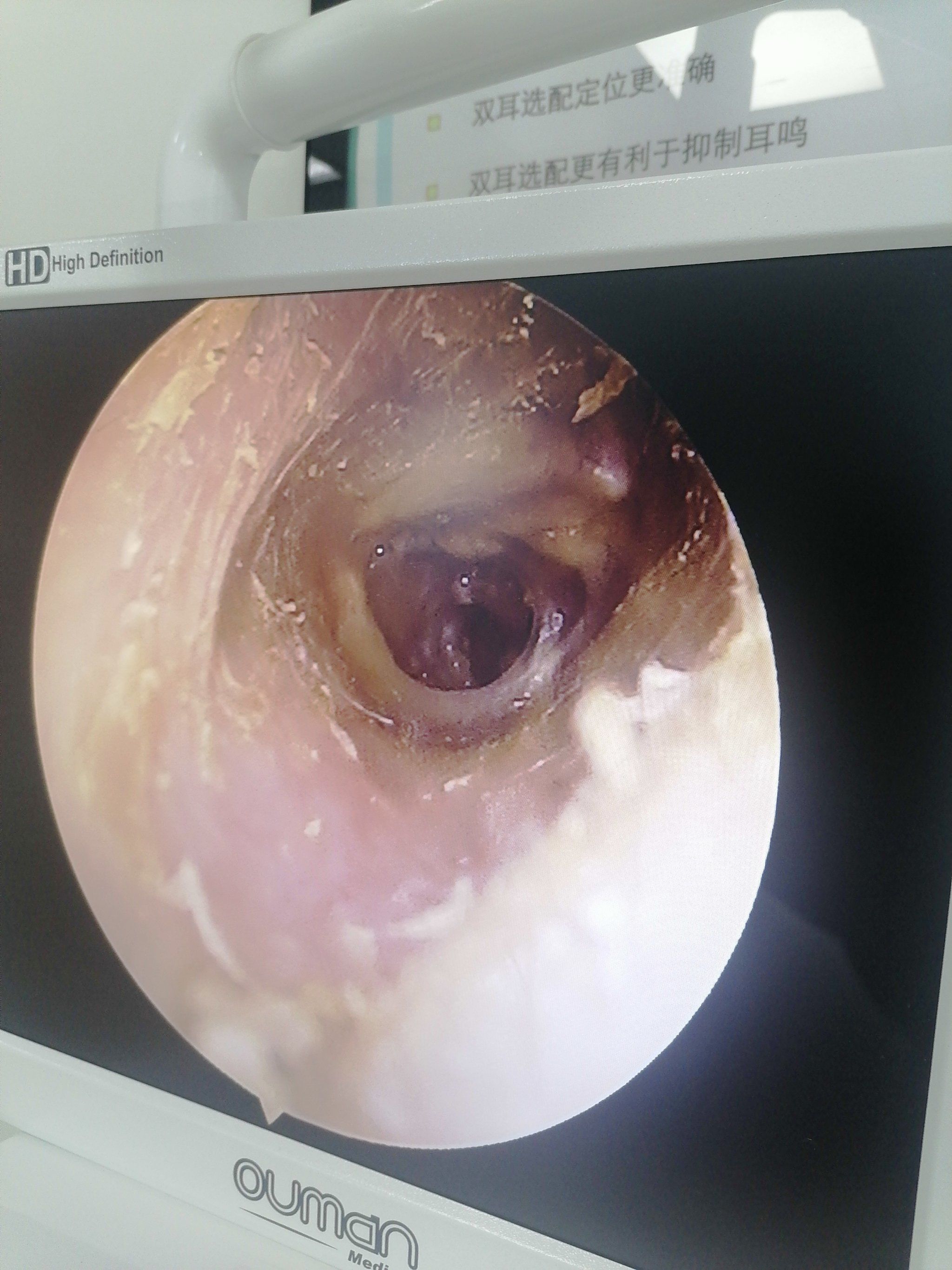 鼓膜异常(声蓝助听器)