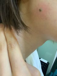 -北京美痣堂古方祛痣斑疣瘊