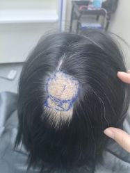 体验前-大麦微针植发全国连锁