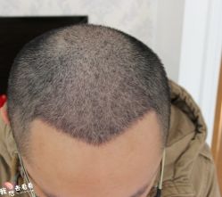 -大麦微针植发丨全国连锁