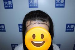体验前-大麦微针植发全国连锁