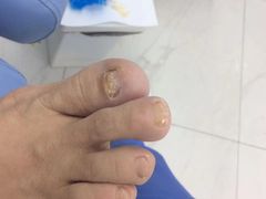 -Andrew指甲专科灰指甲·甲沟炎矫正·3D步态矫形鞋垫定制(浦三路店)