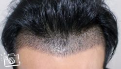 -大麦微针植发丨全国连锁