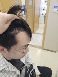 点击看大图 -大麦微针植发全国连锁