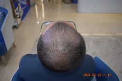 体验后-大麦微针植发全国连锁