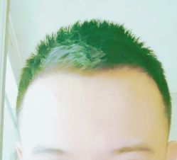 -大麦微针植发丨全国连锁