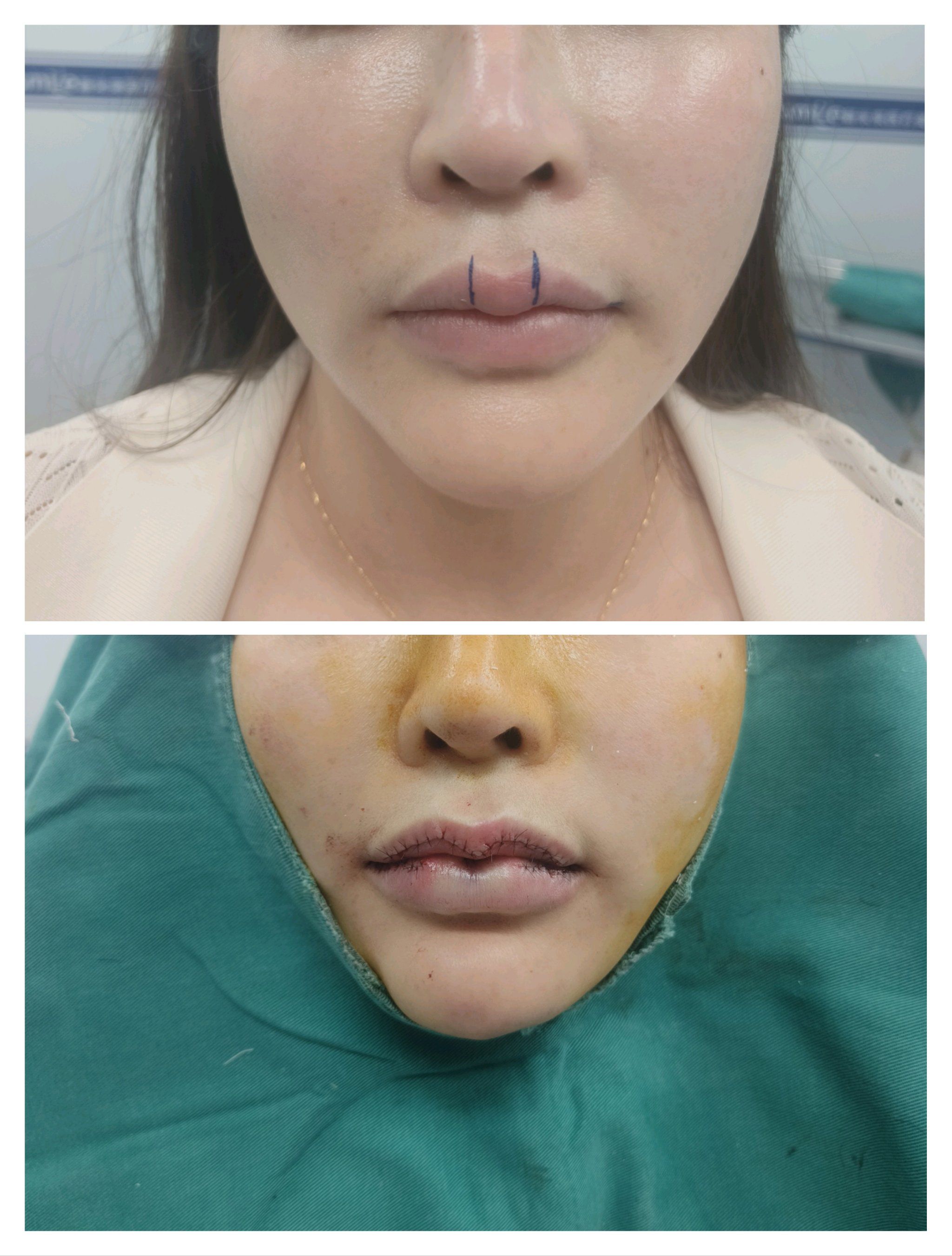 抗衰 m唇术后即刻.太喜欢了我的妈呀.