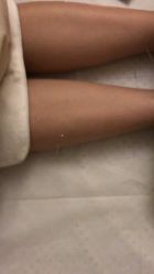 -肥三针腧穴瘦身馆