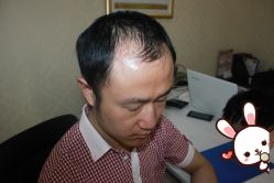 -大麦微针植发丨全国连锁