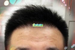 -大麦微针植发全国连锁