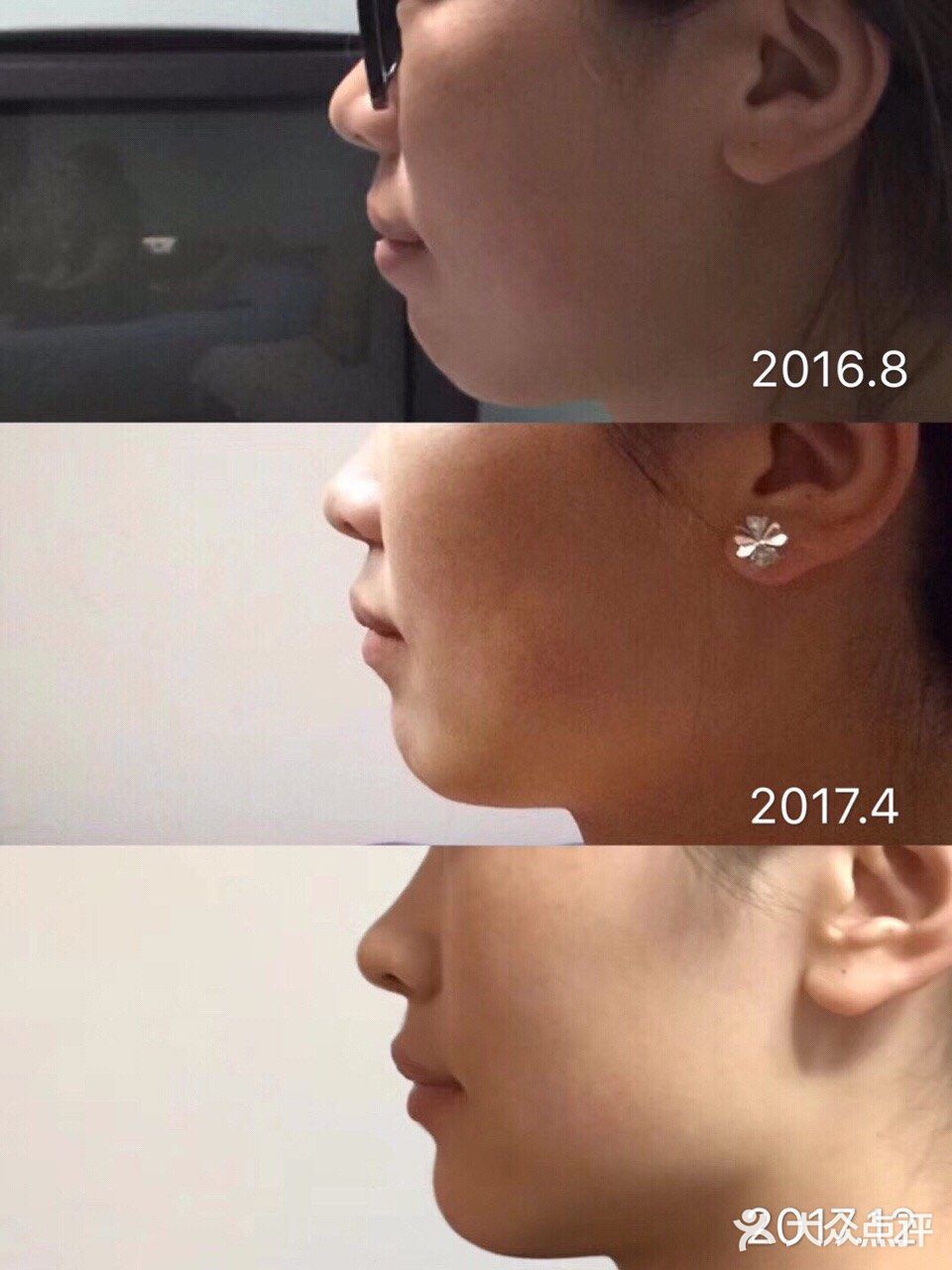 骨性深覆合金属自锁矫正案例 