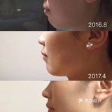 骨性深覆合金属自锁矫正案例 