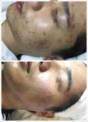 点击看大图 -塑青春&伊肤泉祛痘皮肤管理