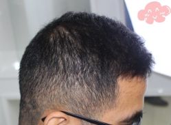 -大麦微针植发丨全国连锁